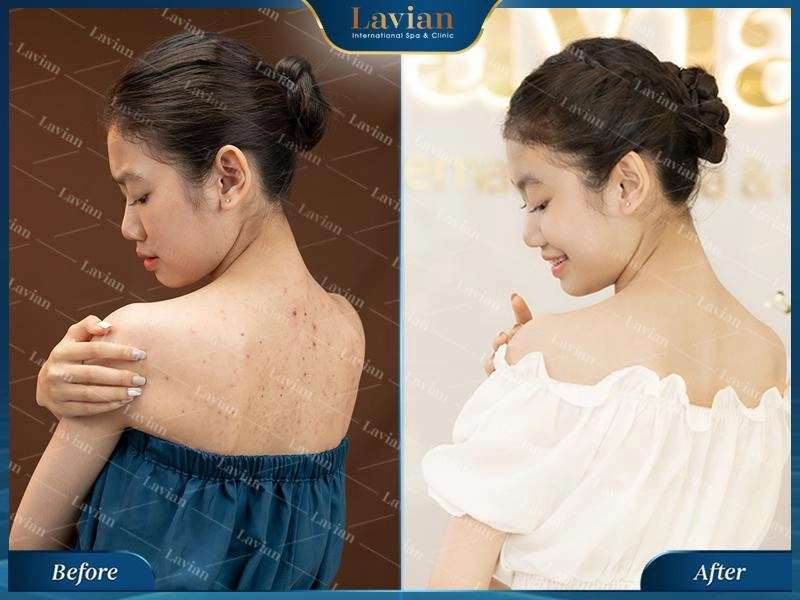 Trị mụn lưng tuổi dậy thì cần lưu ý điều gì - 2