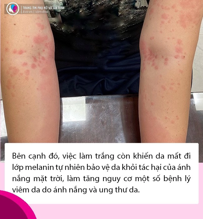 Truyền trắng da đẹp mĩ mãn nhưng nếu không lưu ý mấy điều này kẻo rước họa vào thân - 7