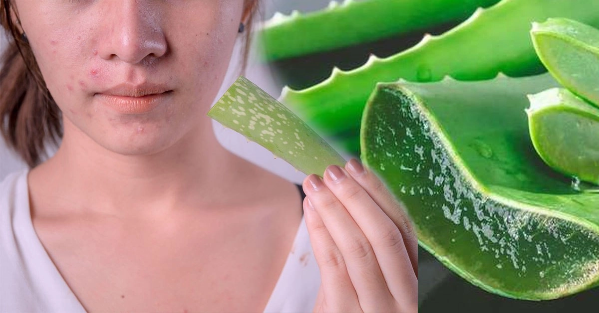 Tuyển tập trị mụn bằng nha đam bai bai làn da khuyết điểm - 1
