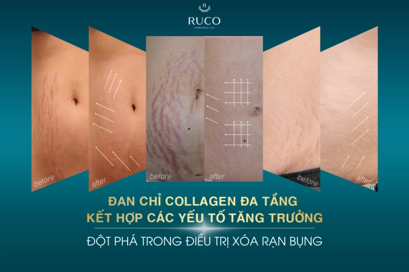 Đan chỉ collagen đa tầng kết hợp plasma tự thân - đột phá trong điều trị xóa rạn bụng - 2