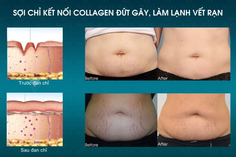 Đan chỉ collagen đa tầng kết hợp plasma tự thân - đột phá trong điều trị xóa rạn bụng - 3