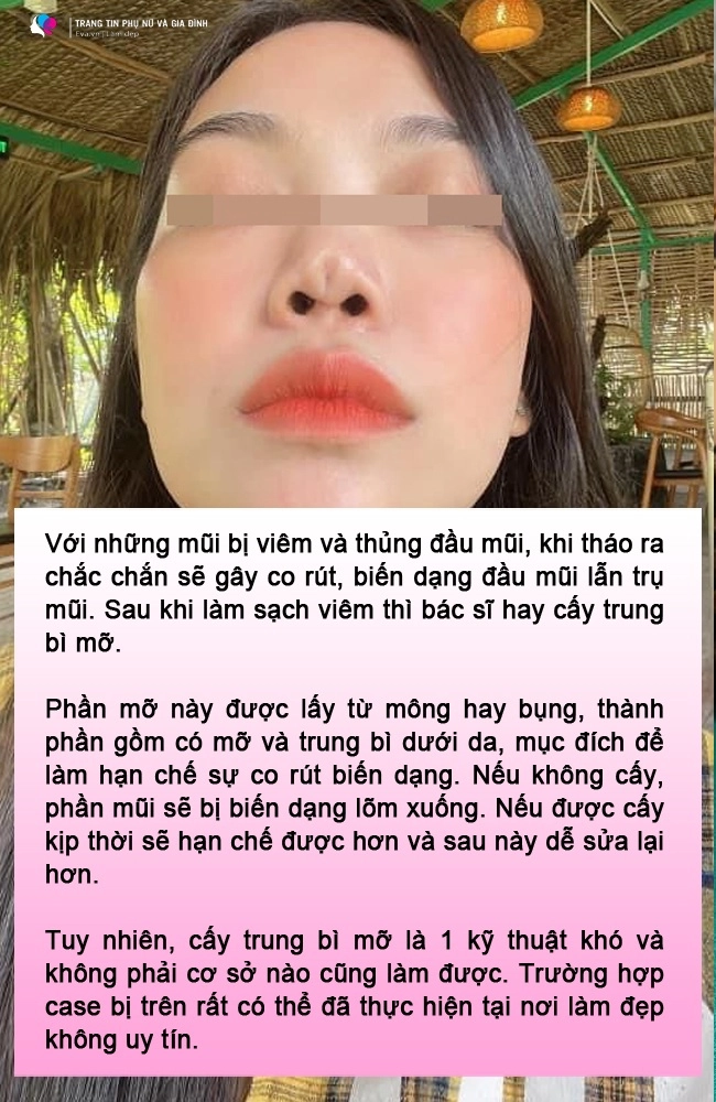 Đòi lấy sụn tai bạn trai nâng mũi gái xinh làm cõi mạng lao đao bác sĩ trả lời thế nào - 9