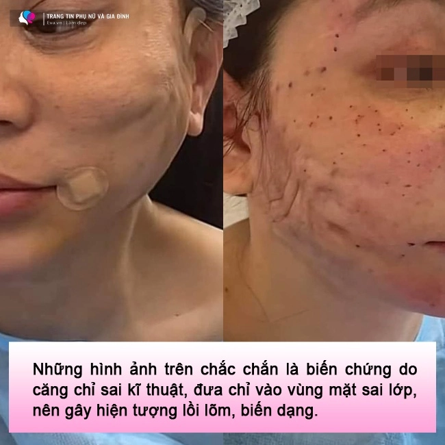 lạnh gáy những pha cấy chỉ căng da của chị em trung niên đẹp chưa thấy ngắm đã xót - 10