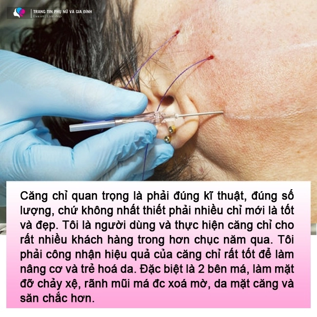 lạnh gáy những pha cấy chỉ căng da của chị em trung niên đẹp chưa thấy ngắm đã xót - 12