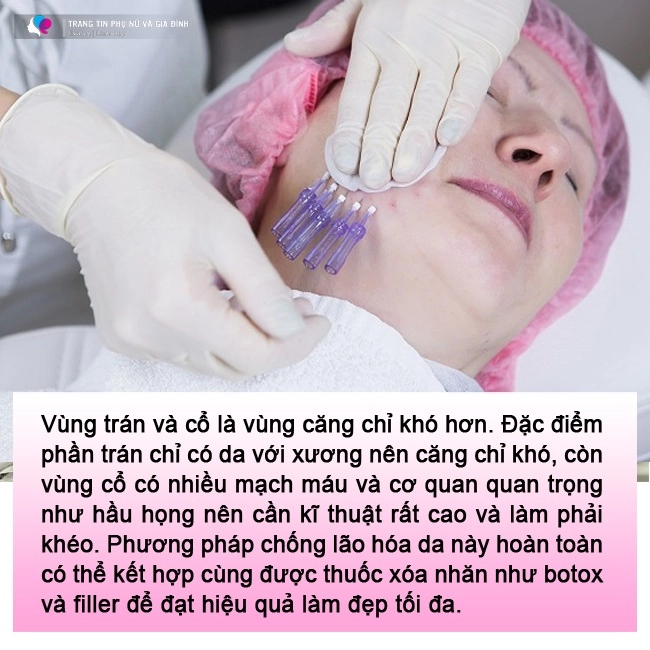 lạnh gáy những pha cấy chỉ căng da của chị em trung niên đẹp chưa thấy ngắm đã xót - 13