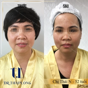 Bác sĩ dr tháp long tiết lộ 3 lưu ý quan trọng sau khi căng chỉ bằng collagen - 2