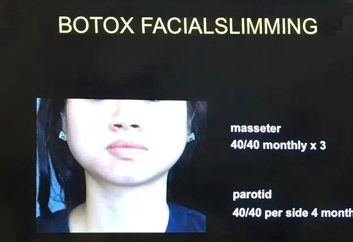 10 năm tiêm botox liên tục từ gương mặt như hình vuông thành cằm vline không cần phẫu thuật - 3