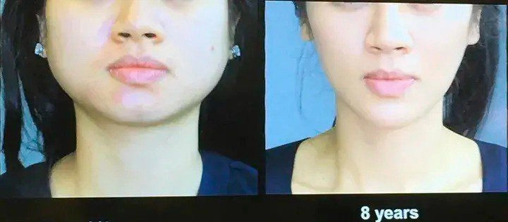 10 năm tiêm botox liên tục từ gương mặt như hình vuông thành cằm vline không cần phẫu thuật - 5