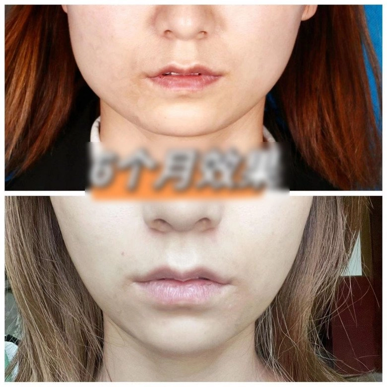 10 năm tiêm botox liên tục từ gương mặt như hình vuông thành cằm vline không cần phẫu thuật - 7