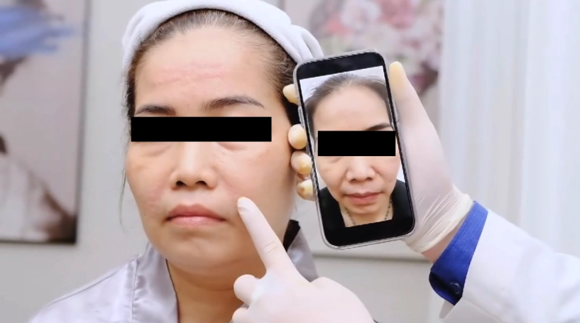 Mesotherapy và các hoạt chất thường dùng trong phương pháp trị liệu da thần kỳ này - 5