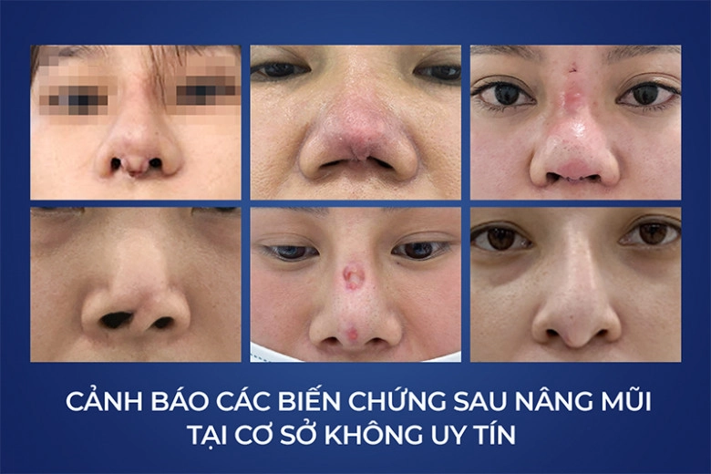 Thsbs vũ quang giải cứu hàng loạt ca mũi hỏng - 1