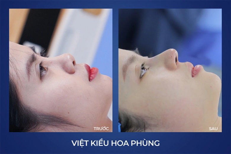 Thsbs vũ quang giải cứu hàng loạt ca mũi hỏng - 3