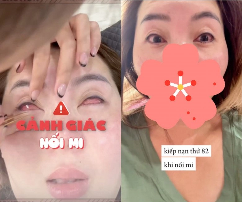 Beauty blogger bị bỏng khi đi nối mi giác mạc thành từng lỗ lời cảnh tỉnh cho chị em - 1