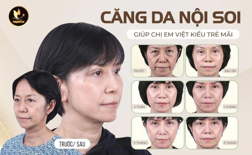 Căng da mặt nội soi xu thế mới giúp chị em việt kiều trẻ mãi - 1