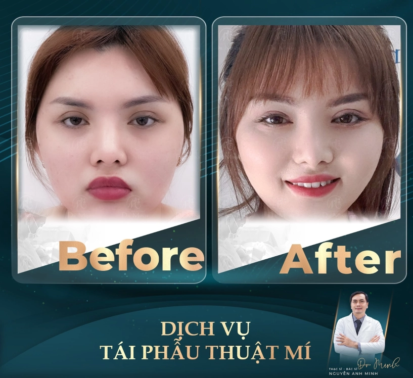 Dr minh - chuyên gia tái phẫu thuật mí hồi sinh đôi mắt hồi sinh tự tin - 2