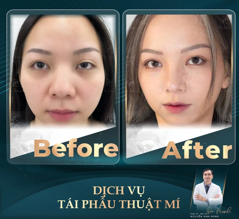 Dr minh - chuyên gia tái phẫu thuật mí hồi sinh đôi mắt hồi sinh tự tin - 3