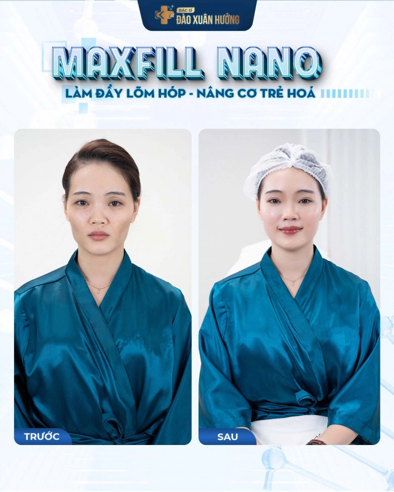 Bác sĩ đào xuân hưởng nhận định như thế nào về phương pháp làm đầy dẫn đầu xu hướng maxfill nano - 4