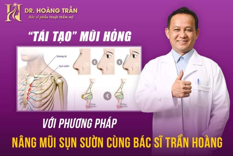 tái tạo mũi hỏng với phương pháp nâng mũi sụn sườn cùng bác sĩ trần hoàng - 1