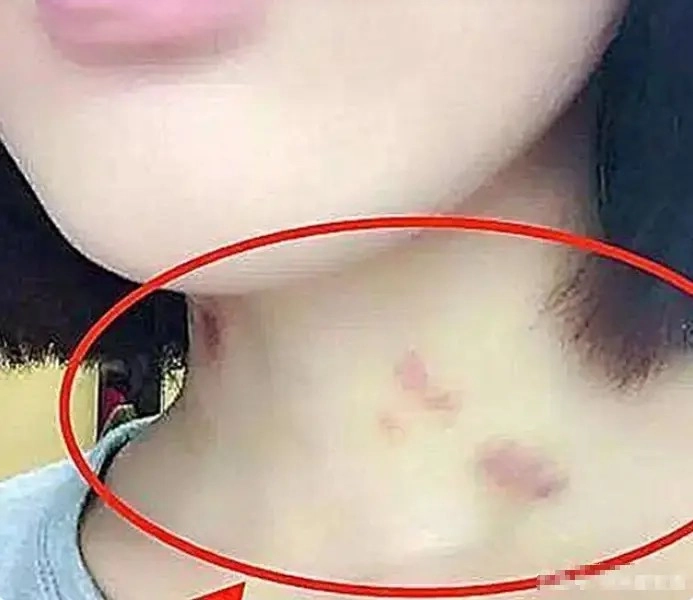 Thấy trên cổ con gái 15 tuổi có vết bầm đỏ biết lý do người bố nổi giận nhưng sau đó liền im bặt khi đứa trẻ lên tiếng - 1