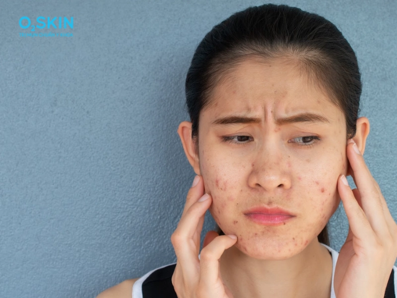 Mụn viêm có tự hết không giải đáp từ bác sĩ o2 skin - 2