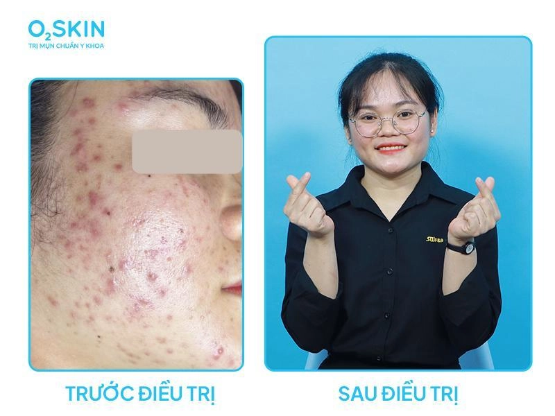 Mụn viêm có tự hết không giải đáp từ bác sĩ o2 skin - 3