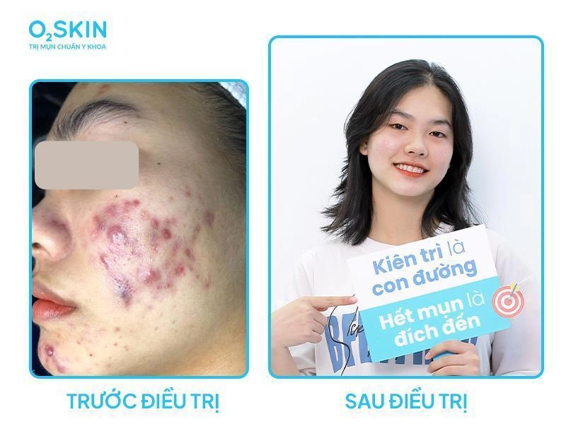 Mụn viêm có tự hết không giải đáp từ bác sĩ o2 skin - 4