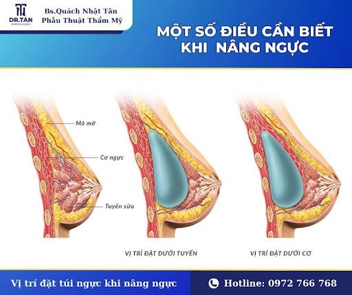 Nâng ngực có cho con bú được không lời giải đáp từ bác sĩ phan huy hoàng - 1