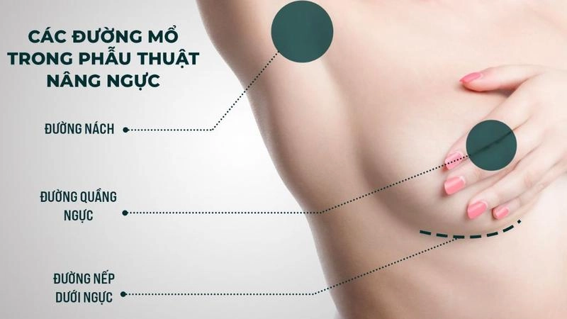 Nâng ngực có cho con bú được không lời giải đáp từ bác sĩ phan huy hoàng - 2