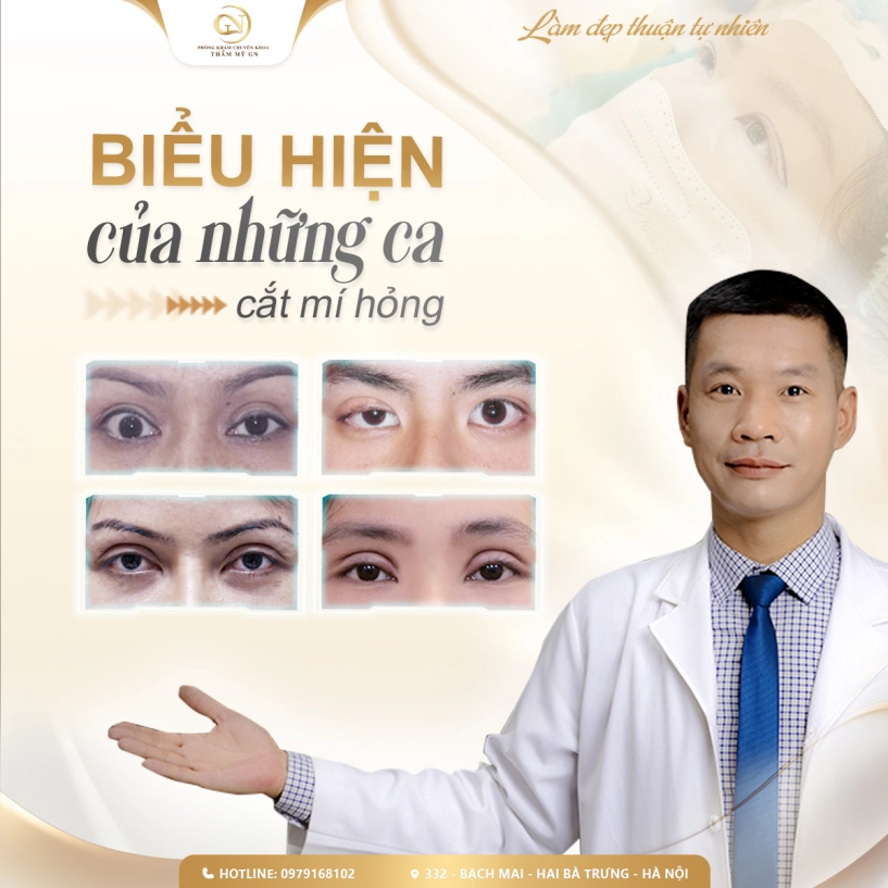 Phẫu thuật chỉnh sửa lại mí mắt do cắt mí lỗi hỏng phức tạp và khó khăn - 1