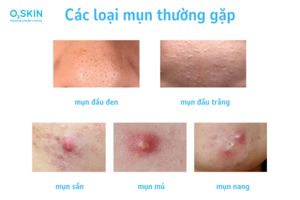 Trị mụn tuổi dậy thì đúng cách nữ sinh bất ngờ thăng hạng nhan sắc sau 2 tháng - 3