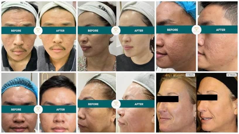 Bác sĩ ckii phạm minh trường chia sẻ về lợi thế của hệ thống rf đa nhiệm tại hội thảo quốc tế fob 2025 - 3