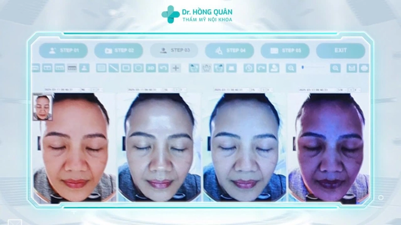 Bác sĩ nguyễn hồng quân và thời điểm vàng cứu làn da chảy xệ - 3