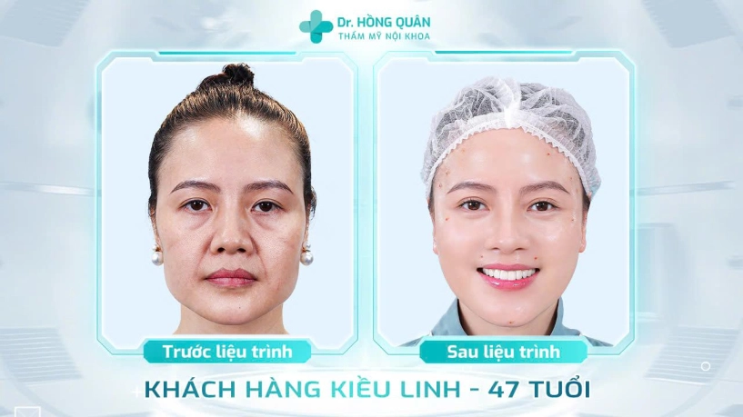 Bác sĩ nguyễn hồng quân và thời điểm vàng cứu làn da chảy xệ - 4
