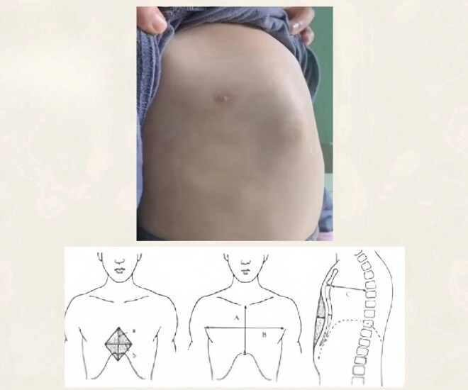 Bé gái mắc bệnh ngực bồ câu lời bác sĩ nói khiến người mẹ hối hận - 3