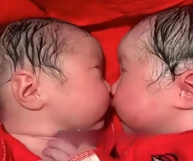 Cặp sinh đôi bám chặt lấy nhau khi mới chào đời y tá không thể tách rời mà phải thốt lên thật hiếm gặp - 3
