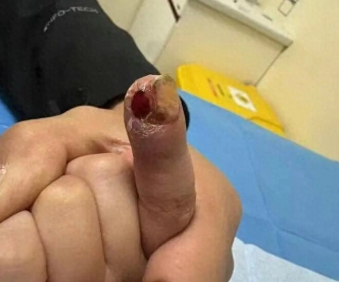 Cậu bé 7 tuổi suýt cắt bỏ ngón tay bác sĩ nói nguyên nhân đến từ thói quen hàng ngày của trẻ người mẹ hối hận - 1
