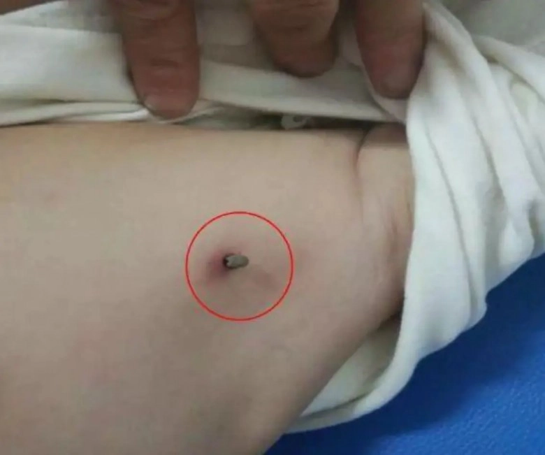 Con bị côn trùng cắn một hành động của người mẹ suýt chút nữa khiến đứa trẻ ra đi mãi mãi - 1