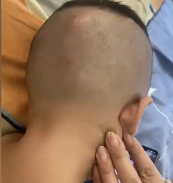 Con đi chơi về mẹ phát hiện đầu bé mọc nhiều khối u lớn như hạt óc chó đến bệnh viện khám liền thất kinh - 3
