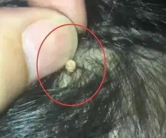 Con kêu đau mẹ bàng hoàng khi phát hiện hạt kê dính chặt ở da đầu bs nói đó là thứ đáng sợ - 1