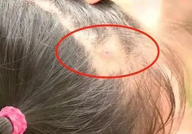 Con kêu đau mẹ bàng hoàng khi phát hiện hạt kê dính chặt ở da đầu bs nói đó là thứ đáng sợ - 2