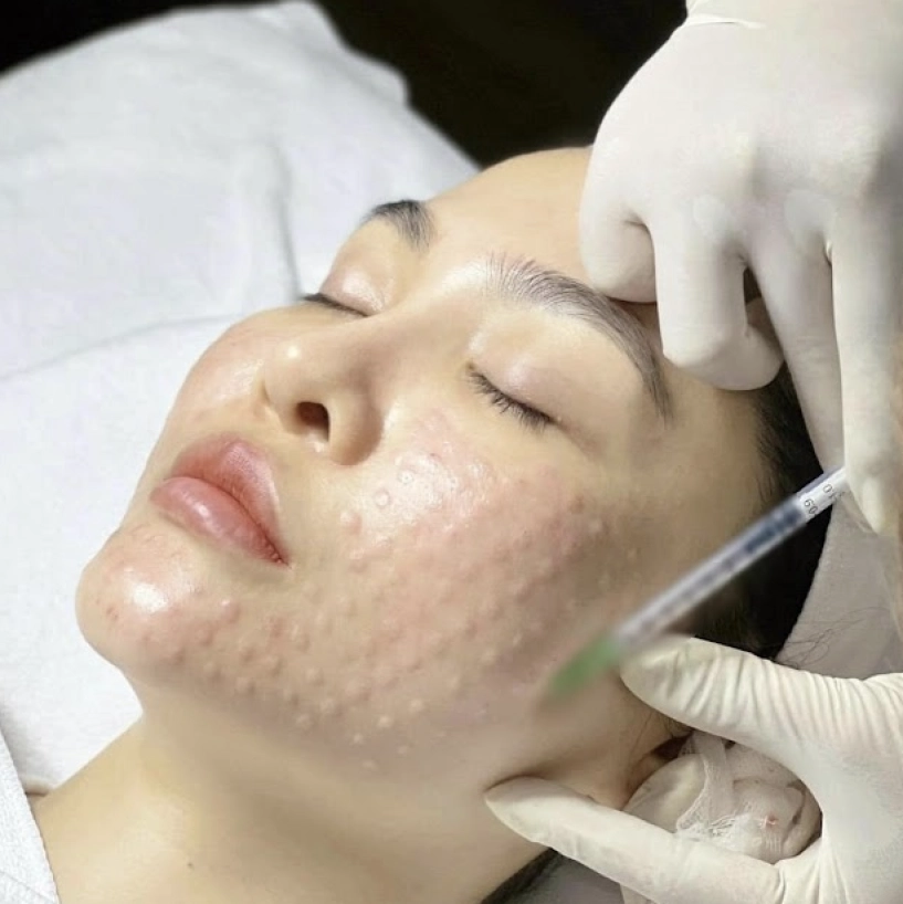 Công nghệ cấy meso không đau không bầm xu hướng mới được dân công sở mê mẩn - 1