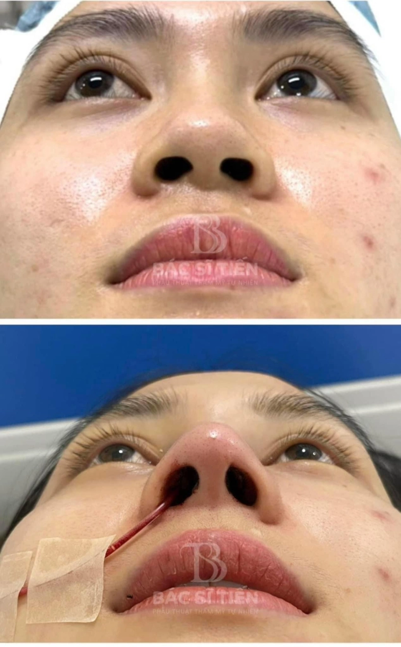 Kỹ thuật nâng mũi cấu trúc kín bước tiến vượt bậc trong thẩm mỹ việt nam - 3