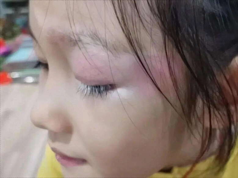 Mẹ phát hiện con gái tiểu học mọc lông mi màu trắng đưa đến bệnh viện bác sĩ lắc đầu quá muộn - 2