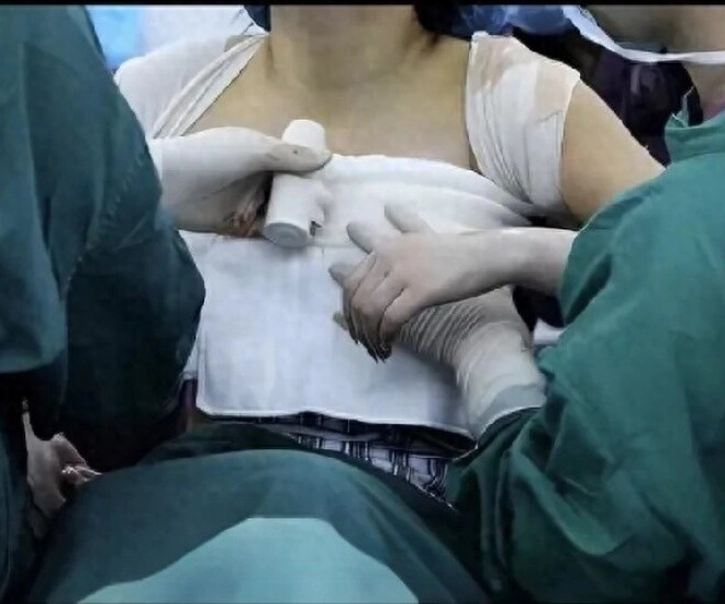Mẹ thấy ngực con gái 13 tuổi sưng đỏ đưa đến bệnh viện bác sĩ phát hiện nhiều vụn giấy kỳ lạ - 1