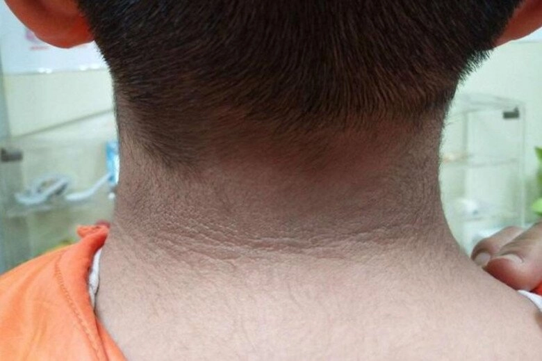 Phát hiện cổ con trai bỗng đen xì nhăn nheo liền đưa đến bệnh viện thấy bác sĩ lắc đầu người mẹ suy sụp - 2