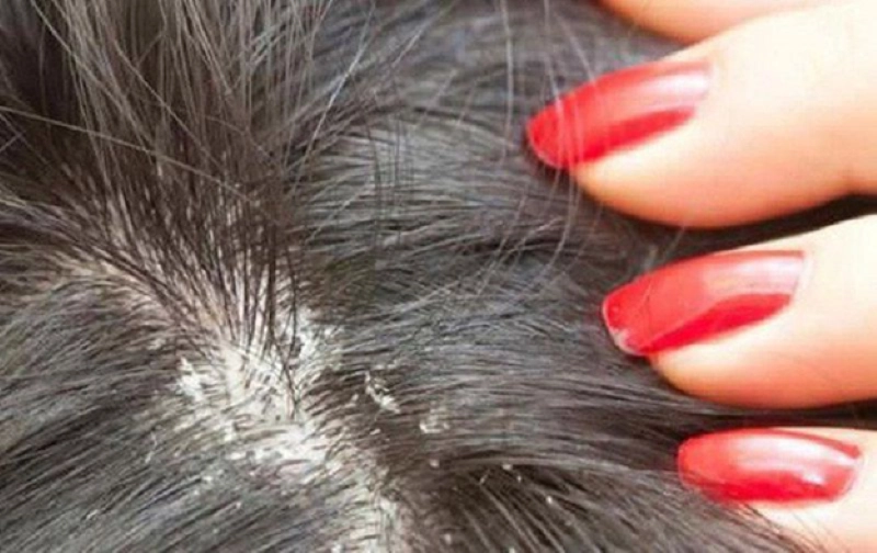 Sản phẩm dầu gội hỗ trợ giảm ngứa da đầu hiệu quả - 1