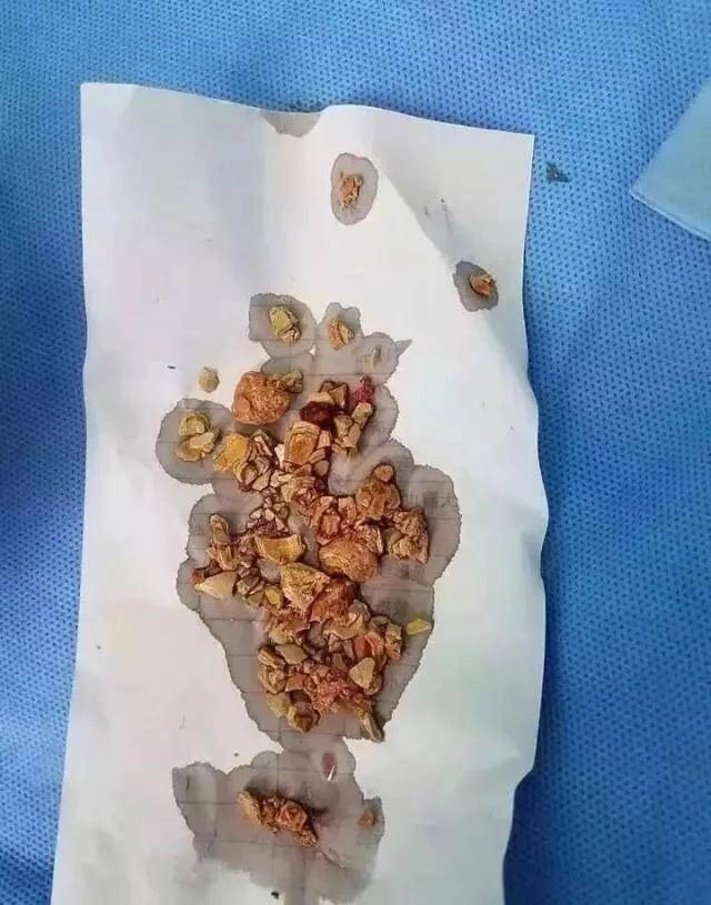 Bé 5 tháng tuổi không đi tiểu trong 20 giờ bị sưng khắp người bác sĩ phát hiện nguyên nhân đến từ bữa ăn hàng ngày - 2