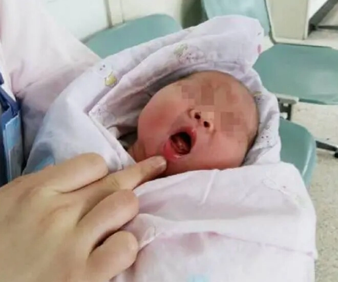 Bé sơ sinh vừa chào đời đã có răng cả khoa hội chẩn phải nhanh lấy nó ra - 1