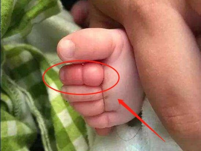 Bố đưa con 2 tuổi đi bơi lúc về phát hiện ngón chân con phù lên đỏ tấy đến bệnh viện bác sĩ báo tin sốc - 1
