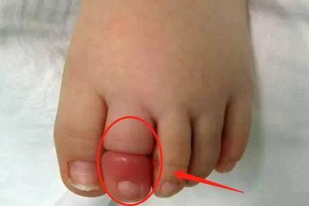 Bố đưa con 2 tuổi đi bơi lúc về phát hiện ngón chân con phù lên đỏ tấy đến bệnh viện bác sĩ báo tin sốc - 2